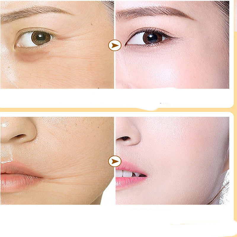 Absorbable Face Filler With Collagen Proteins